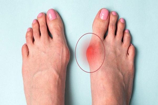 انحراف شست پا را چگونه درمان کنیم؟